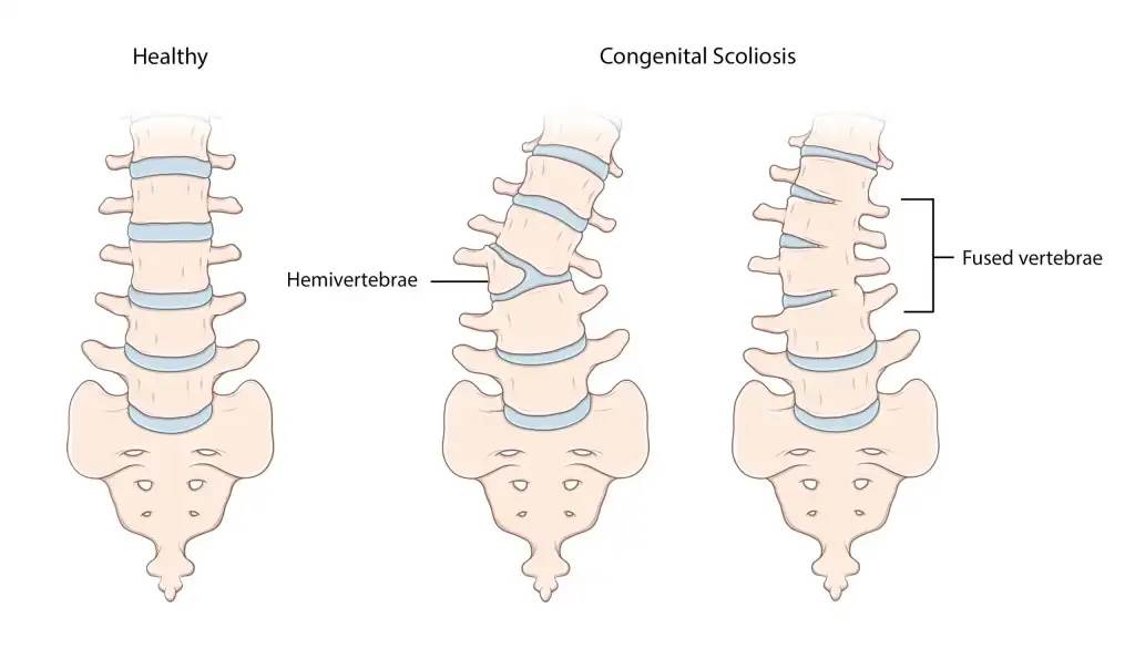 CONGENITAL SPINE PROBLEMS