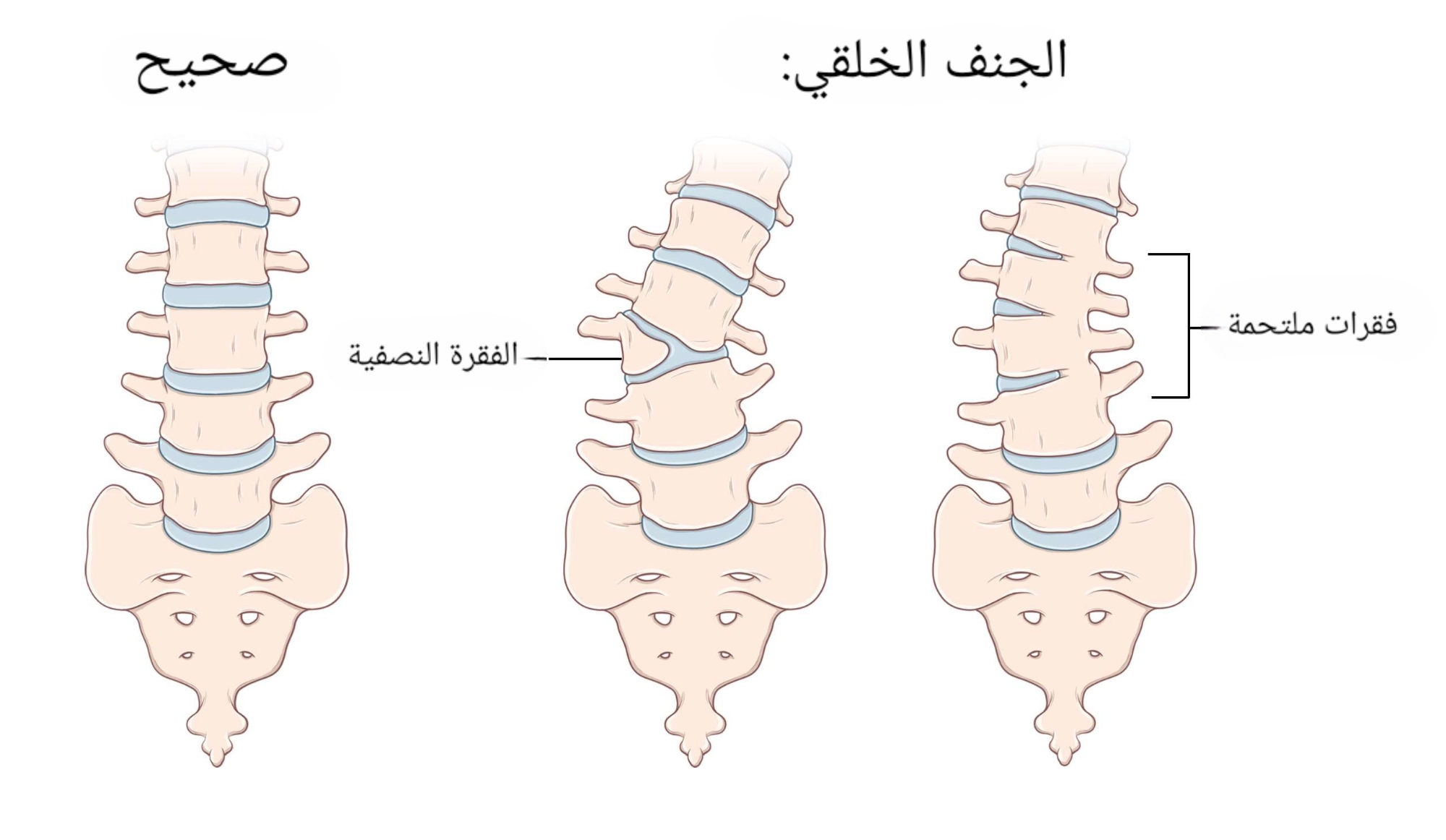 مشاكل العمود الفقري الخلقية