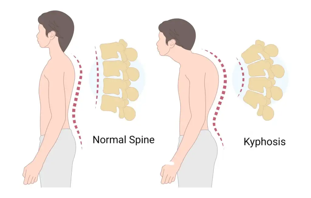 Kyphosis