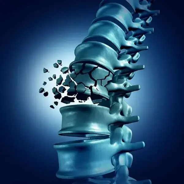 SPINE FRACTURES & TRAUMA